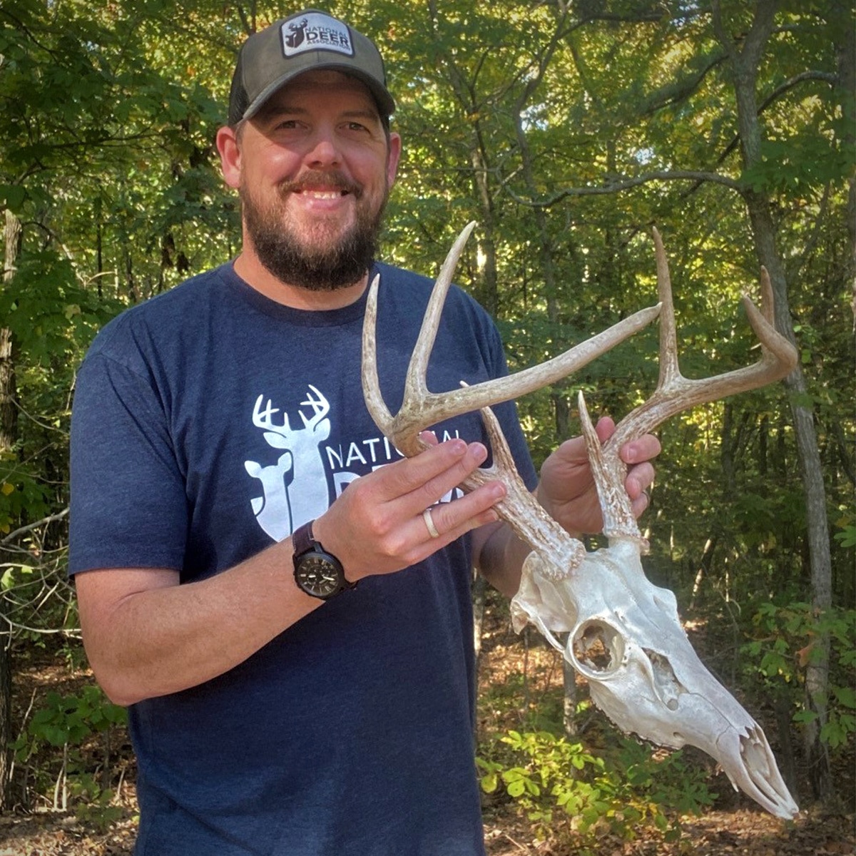 Freak Buck Had Corneal Dermoids. Yes, Hairy Eyeballs.